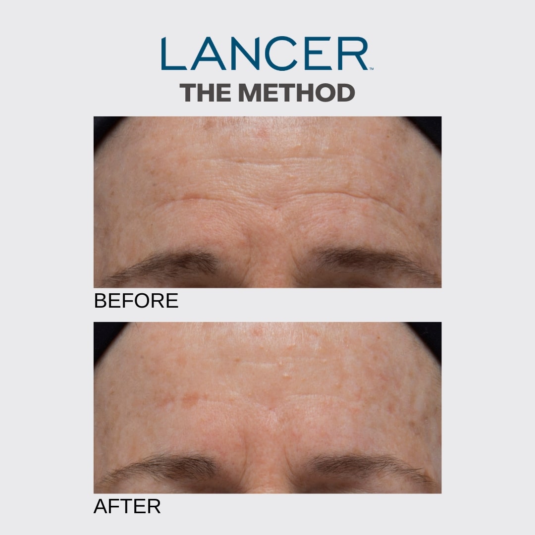 Lancer Skincare Review - Must Read This Before Buying