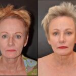 Sculptra Before And After: Transforming Your Appearance With Long ...