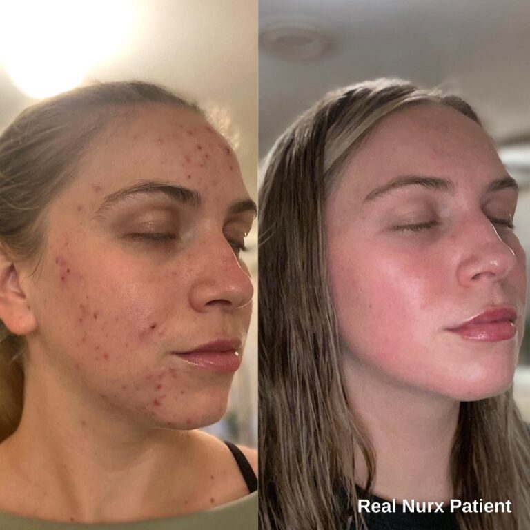 Tretinoin Before and After A Comprehensive Analysis of its