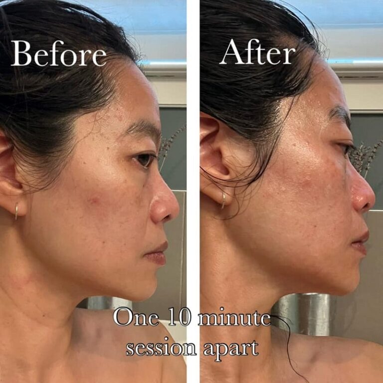 Gua Sha Before And After: Benefits And Results - Must Read This Before ...