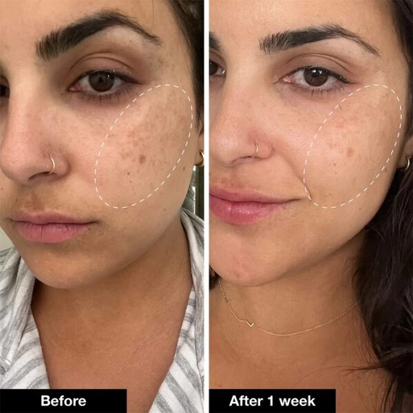 retinol-before-and-after-transform-your-skin-with-these-results-must