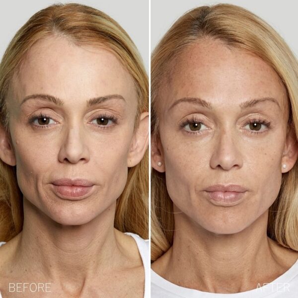 Sculptra Before And After: Transforming Your Appearance With Long