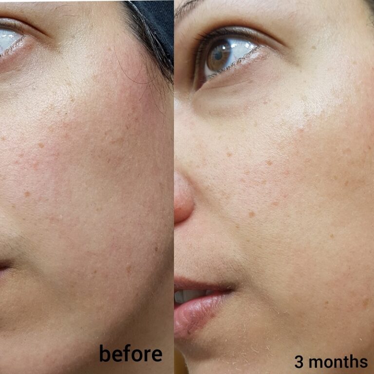 Tretinoin Before And After A Comprehensive Analysis Of Its 