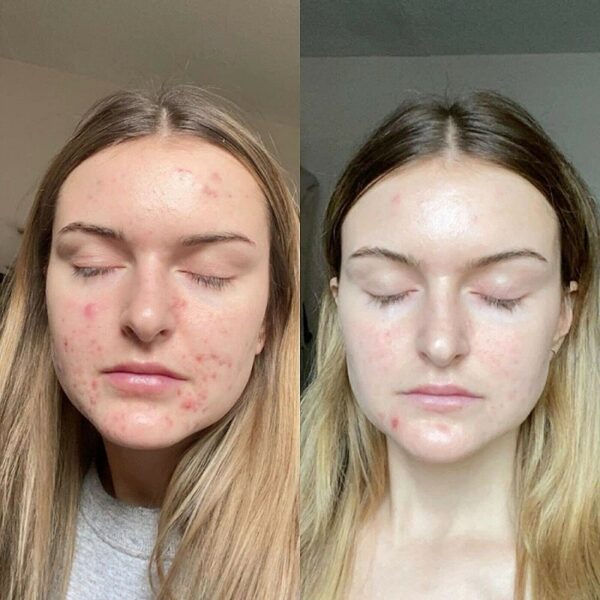 Tretinoin Before and After: A Comprehensive Analysis of its ...