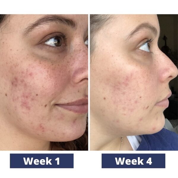 Tretinoin Before and After A Comprehensive Analysis of its