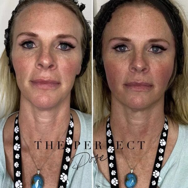 Sculptra Before And After: Transforming Your Appearance With Long ...