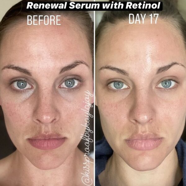 Retinol Before and After Transform Your Skin with These Results Must