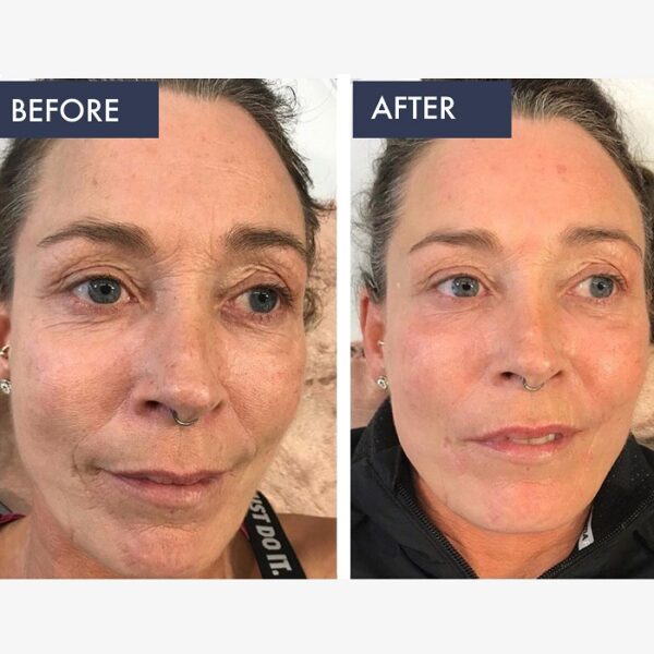 Retinol Before And After Transform Your Skin With These Results Must Read This Before Buying 4568